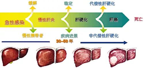 乙肝癥狀及就醫